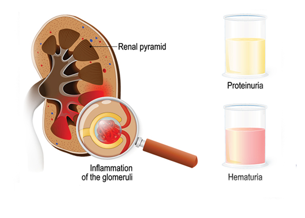 Glomerulonephritis