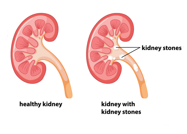 Kidney Stone