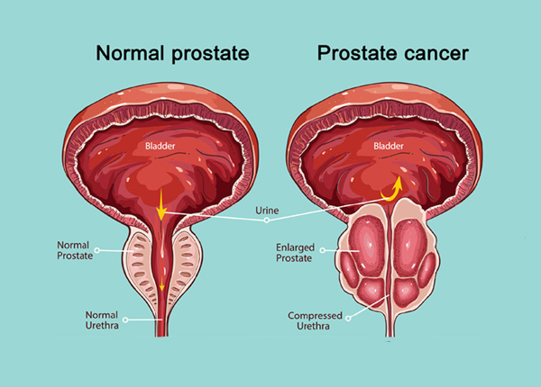 Prostate Problems