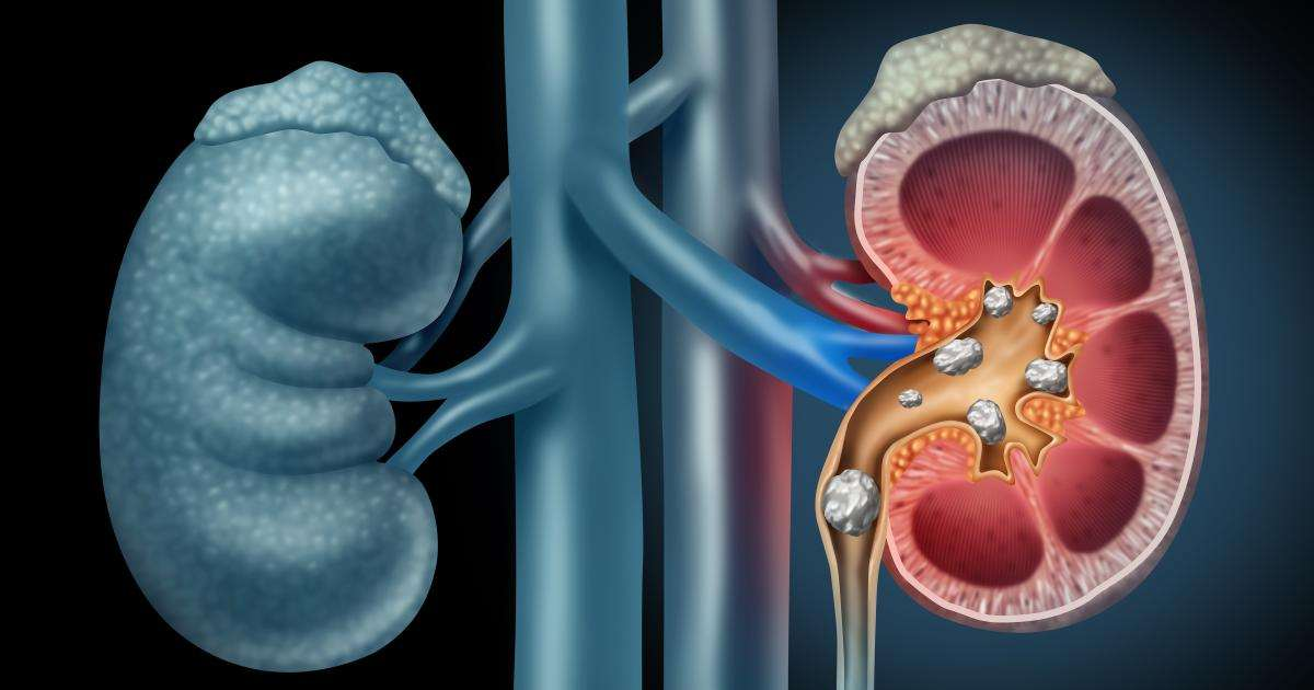 Best Kidney Stone Surgery
