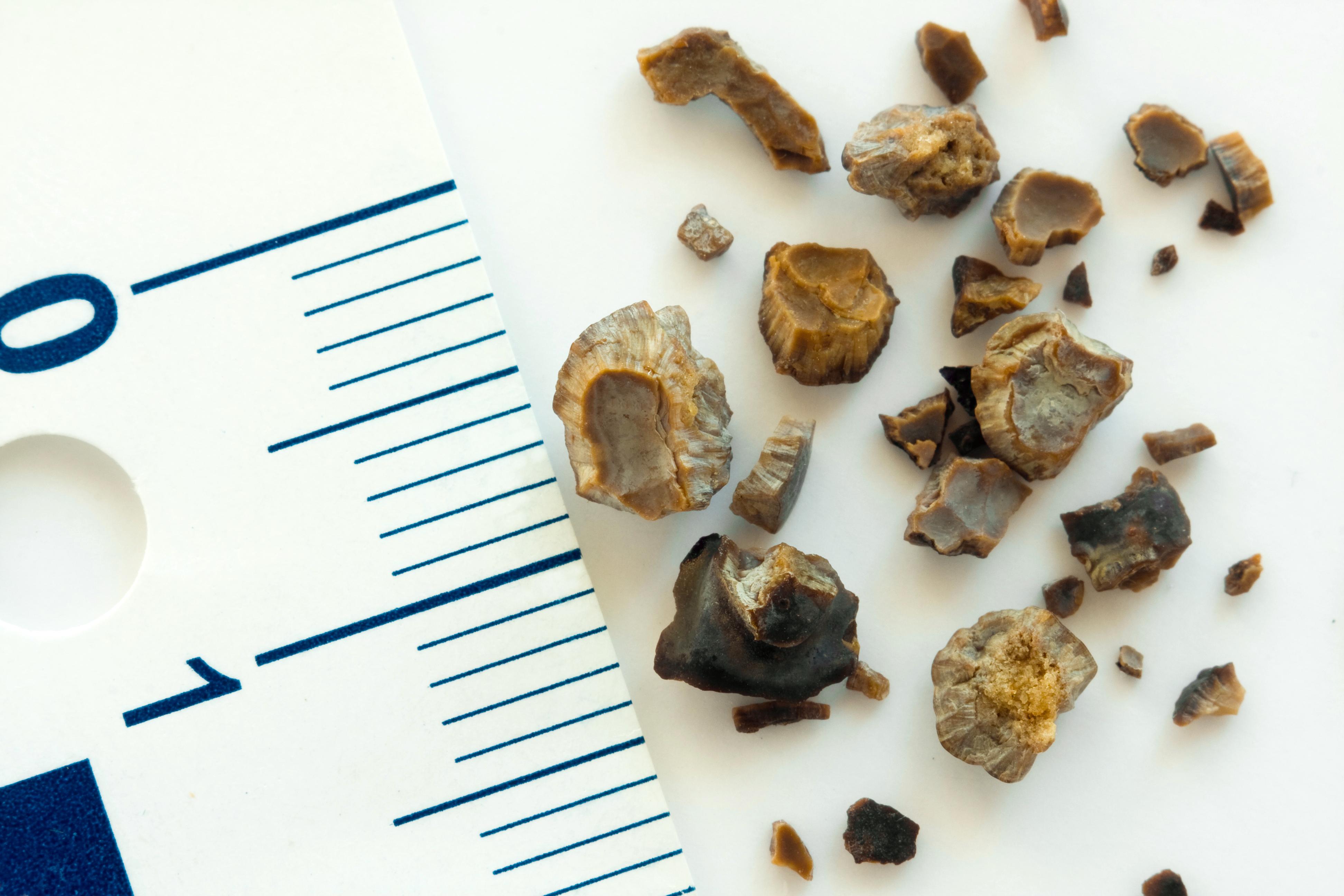 Doctor for Kidney Stone Surgery