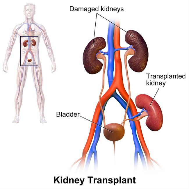 KIDNEY TRANSPLANT