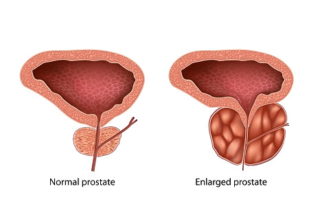 PROSTATE PROBLEM TREATMENT