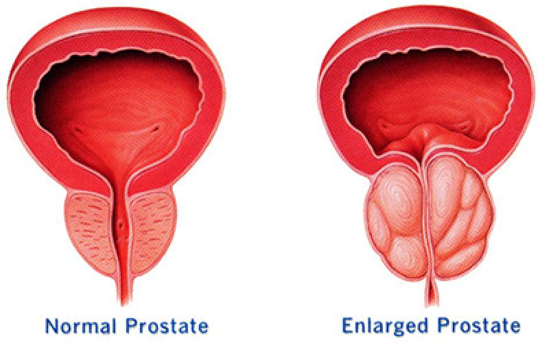 Best Prostate Problem Treatment