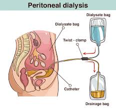 Best Dialysis Treatment