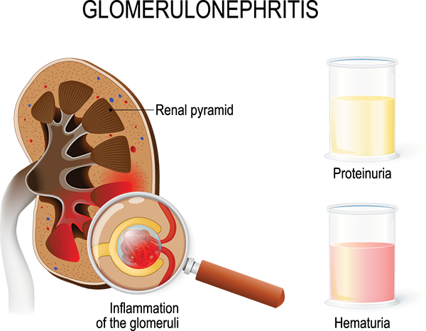 Glomerulonephritis Treatment