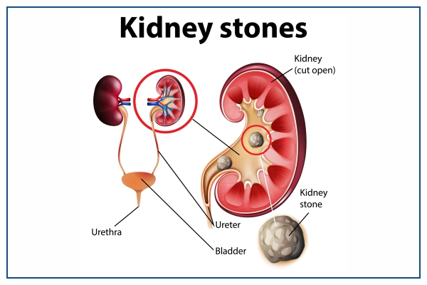 Doctor for Kidney Stone Surgery