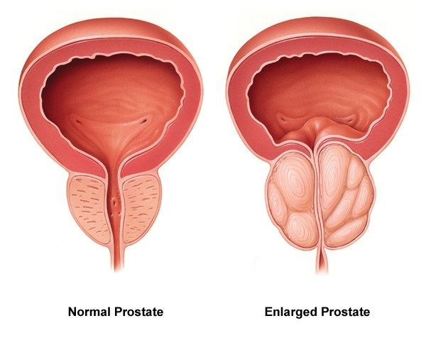 Best Prostate Problem Treatment